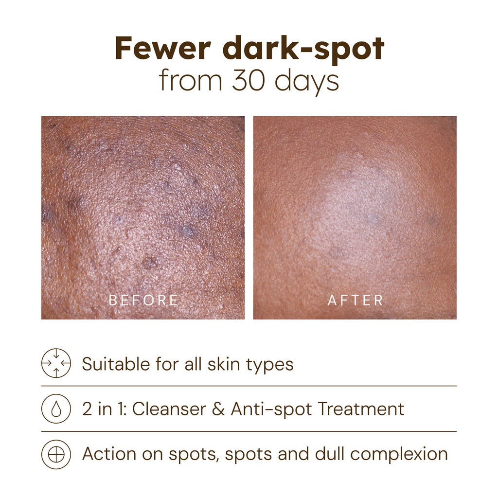 Anti-Blemish Pads